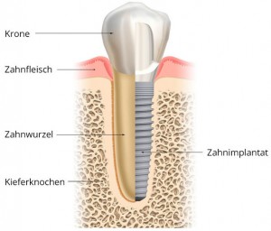 zahn-implantat-erklärung